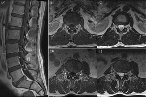 Mri Lumbar Spine T1 Post Gadolinium Sagittal A And Axial B D