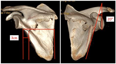 3d Ct Reconstruction Of The Scapula Shows A Mediallateral