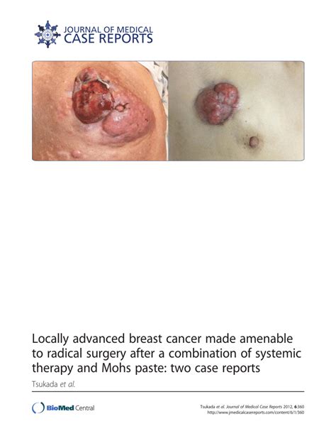 Breast cancer is most often found in women, but men can get breast cancer too. (PDF) Locally advanced breast cancer made amenable to ...