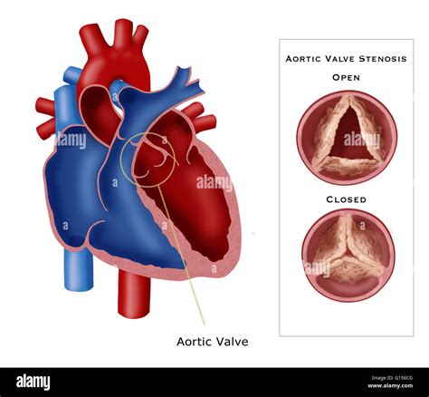 Illustration Of Aortic Valve Stenosis A Type Of Valvular Heart Disease