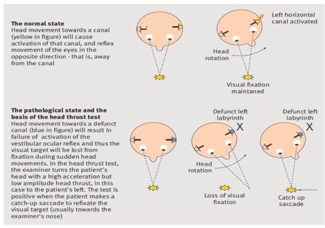 Cme 160114 Vestibular And Vertigo Assessment Charlies Ed