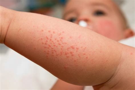 Allergic skin rash is one of the first and most frequent signs of the development of the reaction of the hypersensitivity of the organism to allergens. Could Baby's Rash Be Food-Allergy Related? - Allergic Living