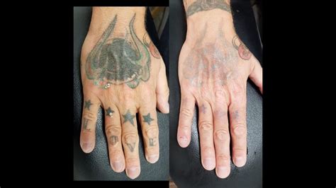 Top 120 How To Remove A Tattoo On Hand