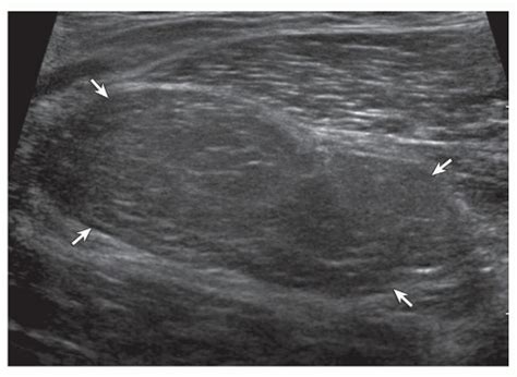 Liposarcoma Low Grade Well Differentiated Ultrasound Image Shows