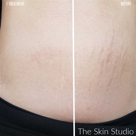 The Best Treatment For Stretch Marks The Skin Studios