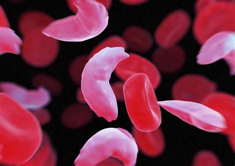What You Should Know About Sickle Cell Disease Odisha Watch