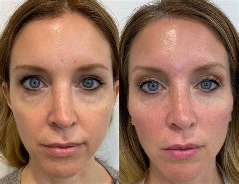 Pdo Thread Lift Before And After Eyes