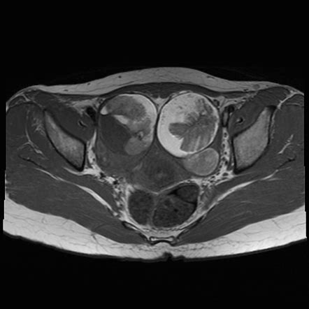 Bilateral Mature Cystic Ovarian Teratomas Radiology Case