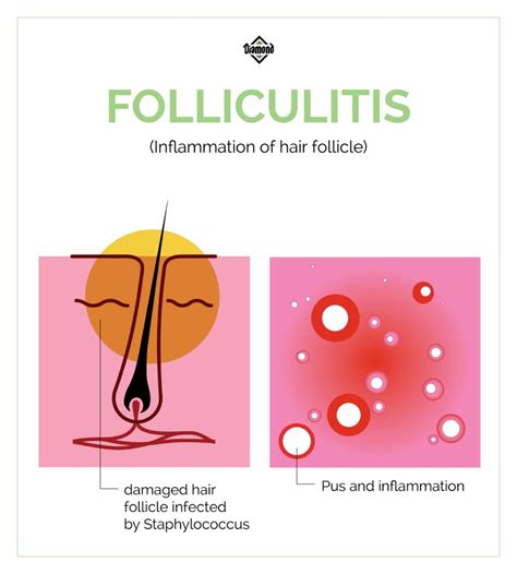A Spotlight On Folliculitis