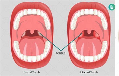 Tonsillitis Symptoms Causes Treatment Medicine Prevention Diagnosis