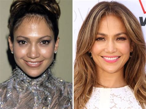 Celebrity Jennifer Lopez Before And After Celebrity Plastic Surgery