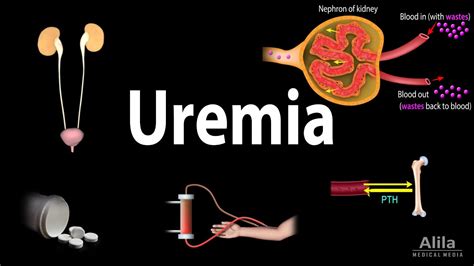 Uremia Pathophysiology Symptoms Diagnosis And Treatment Animation