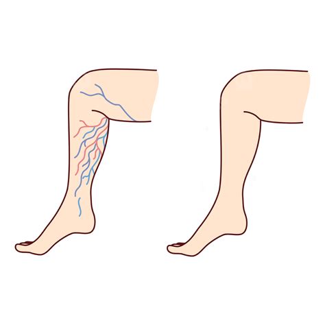 Varicose Veins Diagrams Png Vector Psd And Clipart With Transparent