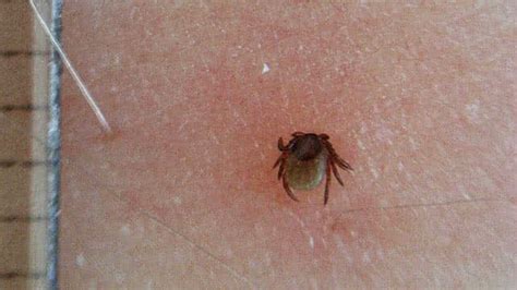 Normal Tick Bite Gallery