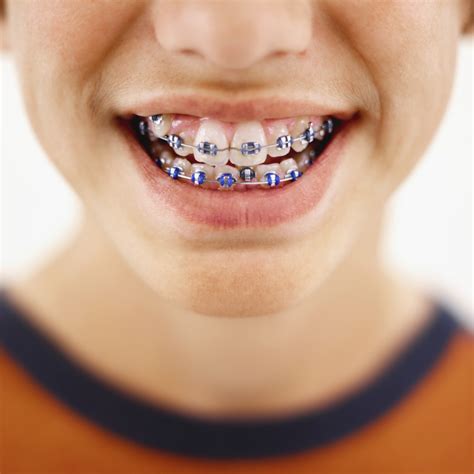 What to Eat When You First Get Braces | Healthy Living