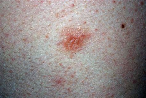 Nummular Dermatitis Nummular Eczema Cancer Therapy Advisor
