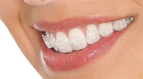 Aparelho De Porcelana Ou Aparelho De Safira Trindade Odontologia