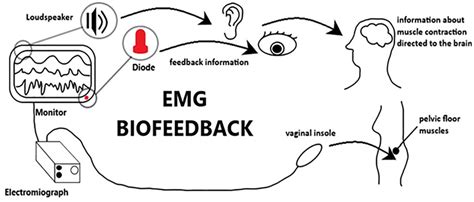Emg Biofeedback Scheme Of Urinary Incontinence Treatment Download