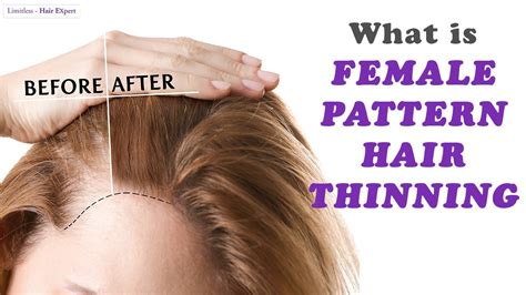 top more than 68 female hair thinning best in eteachers