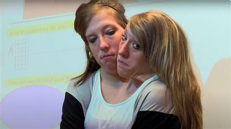 Conjoined Twins Abby And Brittany Marriage 👉👌conjoined Twins And