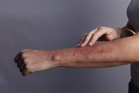 Itchy Skin 11 Causes Pruritius Remedies Diagnosis Steps