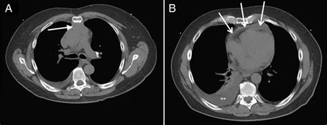 A Rare Cause Of Constrictive Pericarditis Bmj Case Reports