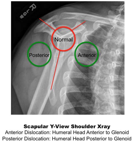 Anterior Shoulder Dislocation X Ray Hopeancehawkins