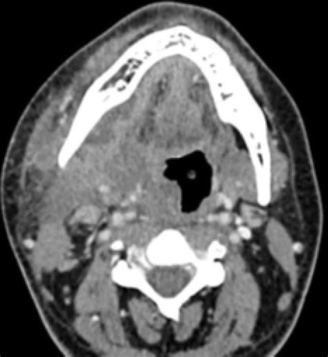 B Contrast Enhanced Neck Ct Coronal And Axial Views A And B Of A