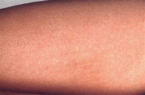 Scarlet Fever In Hong Kong Cases Rise Significantly In Recent Years
