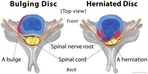 Bulging And Herniated Disc Difference Symptoms Dermatomes Herniated