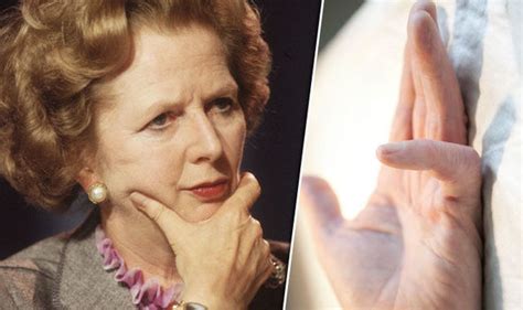 Dupuytrens What Is The Finger Bending Disease Margaret Thatcher Had