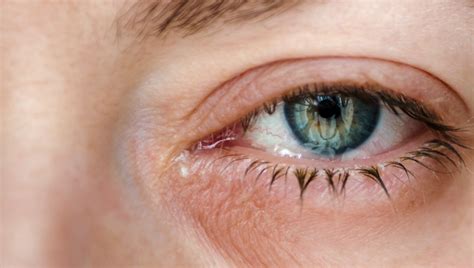 Macular Degeneration Treatment Eye Care For Vision Loss