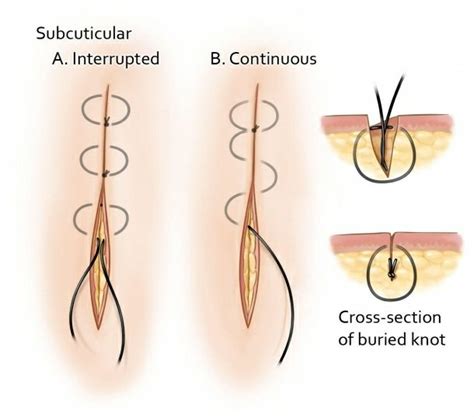 The Subcuticular Suturing Technique Is The Standard Technique For