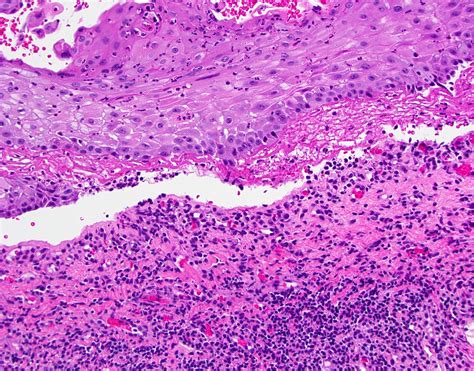 Pathology Outlines Pemphigoid