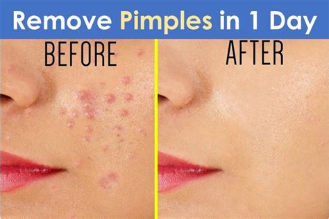How To Remove Pimples From Face In One Day How To Remove Pimples