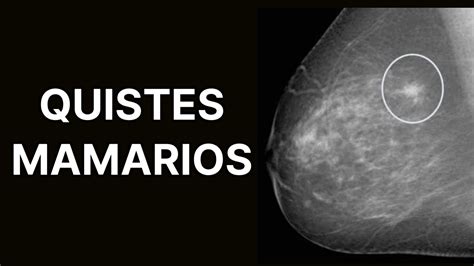 Quistes mamarios síntomas diagnóstico y tratamiento enfermedad fibroquística de la mama