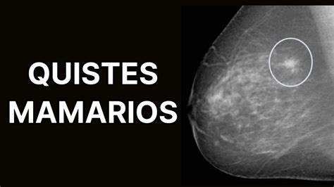 Quistes Mamarios Síntomas Diagnóstico Y Tratamiento Enfermedad Fibroquística De La Mama