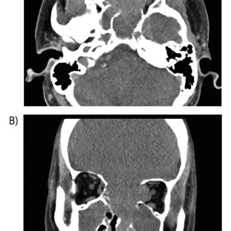 Computed Tomography Ct Scans Of The Head The Axial A Scan Shows A