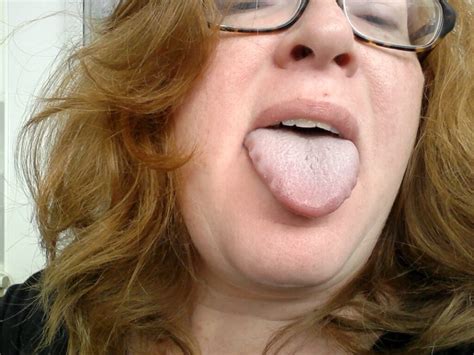 Scalloped Tongue Causes, Pictures, Hypothyroid, Diagnosis & Treatment ...