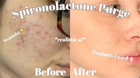 How To Treat Acne From Spironolactone Purge Spironolactone Before And