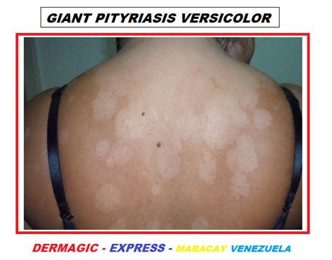 Hypopigmented Pityriasis Versicolor Dermatology Oasis