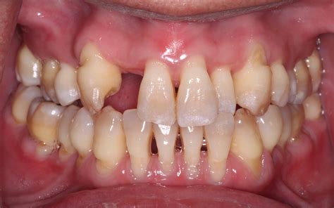 Management Of Gingival Recession In The Orthodontic Patient Seminars