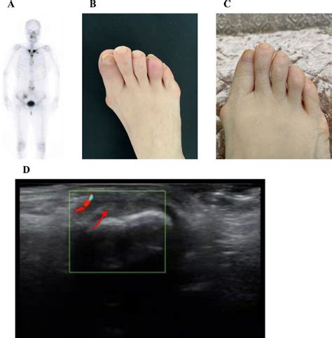 Bone Scintigraphy And Sausage Finger Images Of The Patient With Sapho