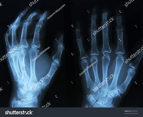X Ray Of Human Left Hand Stock Photo 81821551 Shutterstock