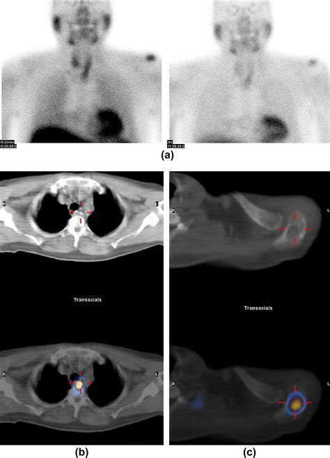 Clinical Utility Of Ultrasound And 99mtc Sestamibi Spectct For Preoperative Localization Of