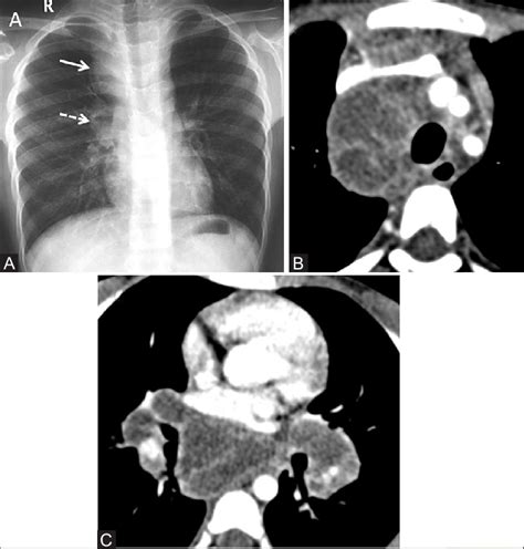 A C Tuberculosis Typical Mediastinal Lymphadenopathy A Chest