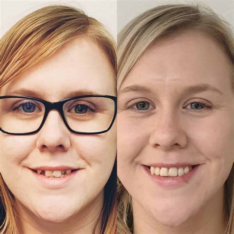 Invisalign® Lincoln Before and After - Kordel House Dental Practice