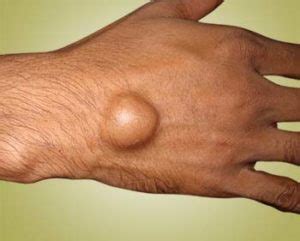 Many people note a large soft bump that can be pushed on a little with some. Ganglion Cyst - GP Core Content