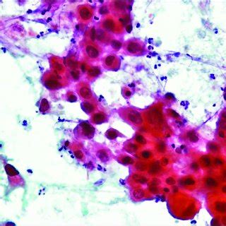 (PDF) Urothelial Bladder Cancer with Cavitary Lung Metastases