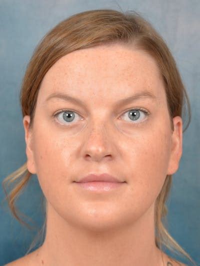 Deep Neck Lift Before And After Photos Starkman Facial Plastic Surgery